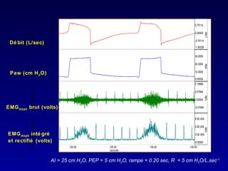 Débit (L/sec) Paw (cm H 2 O) EMG diaph  brut (volts)  EMG diaph  intégré  et rectifié (volts) AI = 25 cm H 2 O, PEP = 5 cm H 2 O, rampe = 0.20 sec, R  = 5 cm H 2 O/L.sec -1 