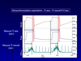 Désynchronisation expiratoire : Ti ass - Ti neural = 0 sec  Mesure Ti ass  (sec) Mesure Ti neural (sec) Débit  Paw EMG diaph 