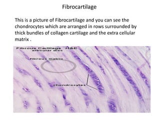 Fibrocartilage

This is a picture of Fibrocartilage and you can see the
chondrocytes which are arranged in rows surrounded by
thick bundles of collagen cartilage and the extra cellular
matrix .
 