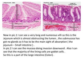 Now in pic.1 I can see a very long and numerous villi so this is the
Jejunum which is almost obstructing the lumen , the submucosa has
got no glands so it has to be the main sight of absorption ( the
jejunum – Small intestine ) .
In pic.2 I can see the mucosa doing invasion downward . Also I can
see that the majority of the lining cells are goblet cells .
So this is a part of the large intestine (Colon) .
 