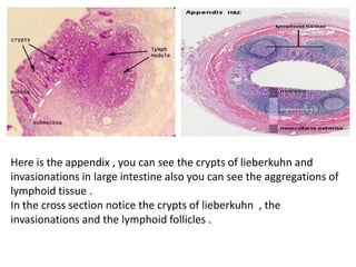 Here is the appendix , you can see the crypts of lieberkuhn and
invasionations in large intestine also you can see the aggregations of
lymphoid tissue .
In the cross section notice the crypts of lieberkuhn , the
invasionations and the lymphoid follicles .
 