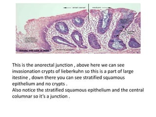 This is the anorectal junction , above here we can see
invasionation crypts of lieberkuhn so this is a part of large
itestine , down there you can see stratified squamous
epithelium and no crypts .
Also notice the stratified squamous epithelium and the central
columnar so it’s a junction .
 