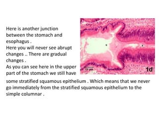 Here is another junction
between the stomach and
esophagus .
Here you will never see abrupt
changes .. There are gradual
changes .
As you can see here in the upper
part of the stomach we still have
some stratified squamous epithelium . Which means that we never
go immediately from the stratified squamous epithelium to the
simple columnar .
 
