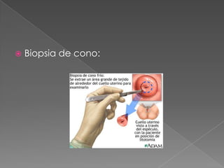  Biopsia de cono:
 