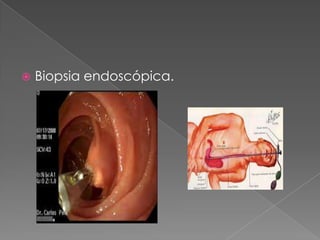  Biopsia endoscópica.
 