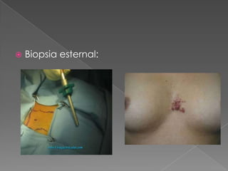  Biopsia esternal:
 