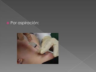  Por aspiración:
 