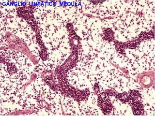 GANGLIO LINFÁTICO MÉDULA
 