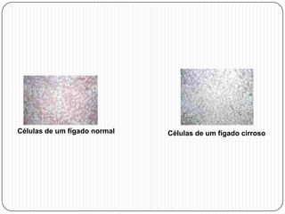 Células de um fígado normal Células de um fígado cirroso
 