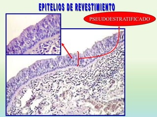 PSEUDOESTRATIFICADO
 