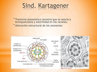 *Trastorno autosomico recesivo que se asocia a
bronquiectasia y esterilidad en los varones.
*Alteración estructural de los axonemas
 