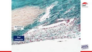 M. Tesen
Red
trabecular
 