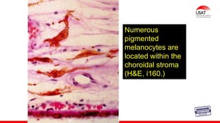 M. Tesen
Numerous
pigmented
melanocytes are
located within the
choroidal stroma
(H&E, í160.)
 