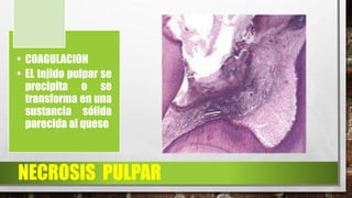 NECROSIS PULPAR
• COAGULACION
• EL tejido pulpar se
precipita o se
transforma en una
sustancia sólida
parecida al queso
 