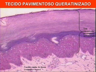 TECIDO PAVIMENTOSO QUERATINIZADO 