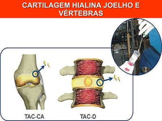 CARTILAGEM HIALINA JOELHO E VÉRTEBRAS 