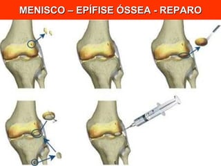 MENISCO – EPÍFISE ÓSSEA - REPARO 