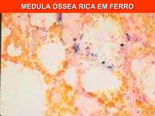 MEDULA ÓSSEA RICA EM FERRO 