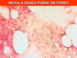 MEDULA ÓSSEA POBRE EM FERRO 