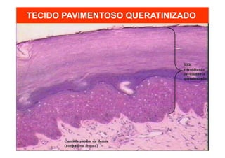 TECIDO PAVIMENTOSO QUERATINIZADO
 