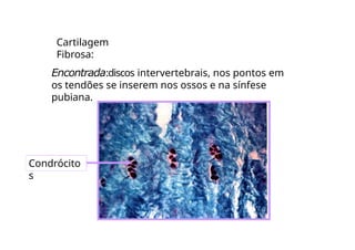 Cartilagem
Fibrosa:
Encontrada:discos intervertebrais, nos pontos em
os tendões se inserem nos ossos e na sínfese
pubiana.
Condrócito
s
 