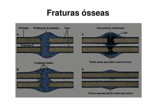Fraturas ósseas
 