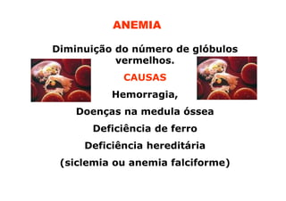 ANEMIA
Diminuição do número de glóbulos
vermelhos.
CAUSAS
Hemorragia,
Doenças na medula óssea
Deficiência de ferro
Deficiência hereditária
(siclemia ou anemia falciforme)

 