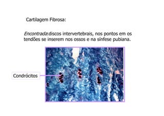 Cartilagem Fibrosa:
Encontrada:discos intervertebrais, nos pontos em os
tendões se inserem nos ossos e na sínfese pubiana.
Condrócitos
 