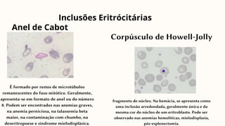 Anel de Cabot
É formado por restos de microtúbulos
remanescentes do fuso mitótico. Geralmente,
apresenta-se em formato de anel ou do número
8. Podem ser encontrados nas anemias graves,
na anemia perniciosa, na talassemia beta
maior, na contaminação com chumbo, na
deseritropoese e síndrome mielodisplásica.
Inclusões Eritrócitárias
Corpúsculo de Howell-Jolly
fragmento de núcleo. Na hemácia, se apresenta como
uma inclusão arredondada, geralmente única e da
mesma cor do núcleo de um eritroblasto. Pode ser
observado nas anemias hemolíticas, mielodisplasia,
pós-esplenectomia.
 