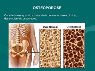 OSTEOPOROSE
Caracteriza-se quando a quantidade de massa óssea diminui,
desenvolvendo ossos ocos.
 