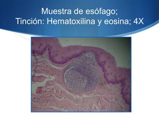 Muestra de esófago; Tinción: Hematoxilina y eosina; 4X 