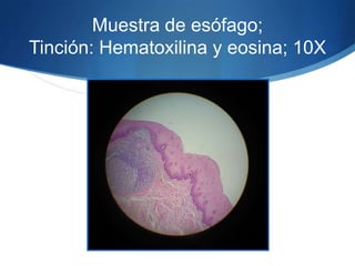 Muestra de esófago; Tinción: Hematoxilina y eosina; 10X 