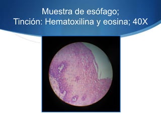 Muestra de esófago; Tinción: Hematoxilina y eosina; 40X 