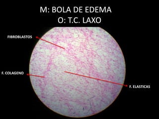 M: BOLA DE EDEMA
O: T.C. LAXO
F. COLAGENO
F. ELASTICAS
FIBROBLASTOS
 
