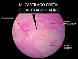 M: CARTILAGO COSTAL
O: CARTILAGO HIALINO
GRUPO
ISOGENO
CONDROCITOS
CAPSULA
CARTILAGINOSA
 