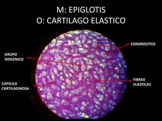 M: EPIGLOTIS
O: CARTILAGO ELASTICO
CONDROCITOS
FIBRAS
ELASTICAS
GRUPO
ISOGENICO
CAPSULA
CARTILAGINOSA
 