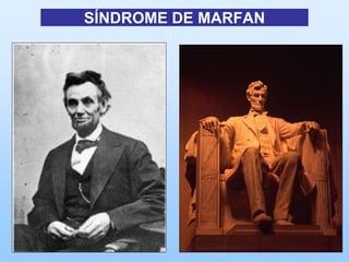 SÍNDROME DE MARFAN
 