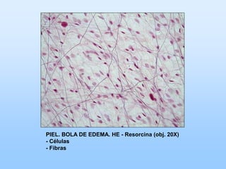 PIEL. BOLA DE EDEMA. HE - Resorcina (obj. 20X)
- Células
- Fibras
 