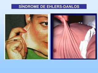 SÍNDROME DE EHLERS-DANLOS
 