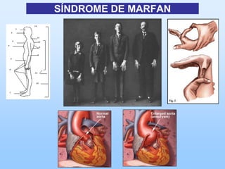 SÍNDROME DE MARFAN
 