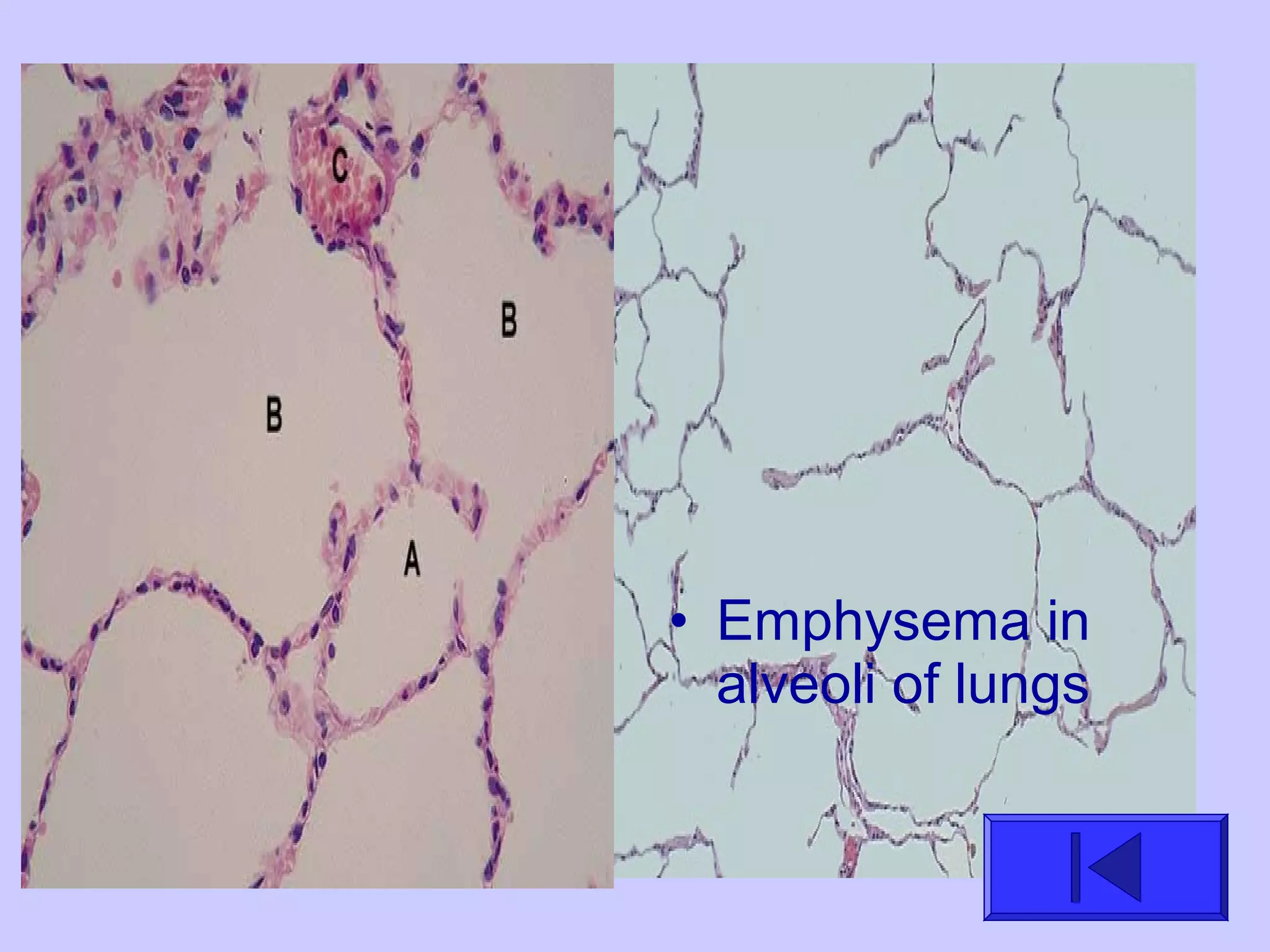 • Emphysema in
alveoli of lungs
 