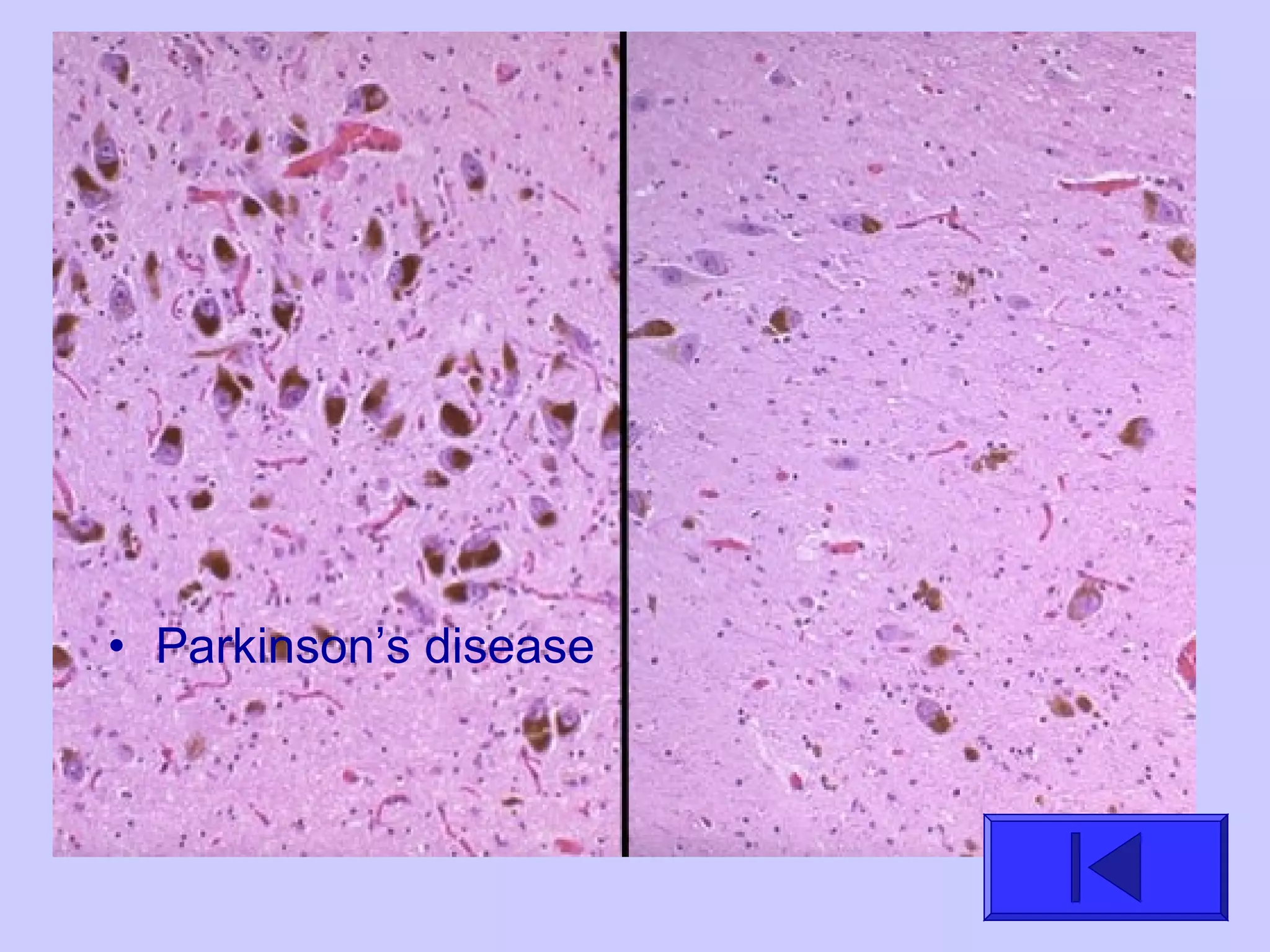 • Parkinson’s disease
 