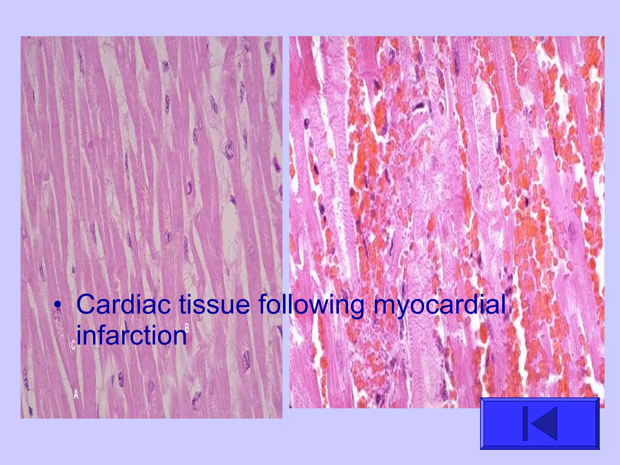 • Cardiac tissue following myocardial
infarction
 