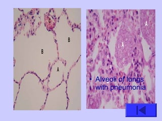 • Alveoli of lungs
with pneumonia
 