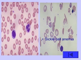• Sickle cell anemia
 