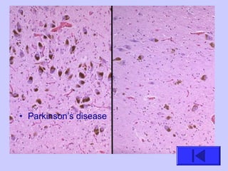 • Parkinson’s disease
 