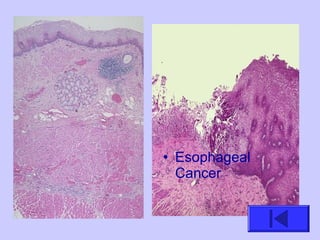 • Esophageal
Cancer
 