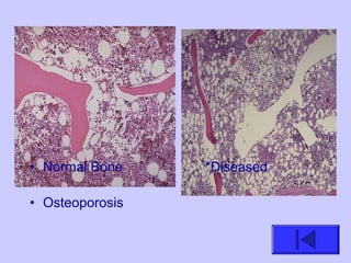 • Normal Bone *Diseased
• Osteoporosis
 
