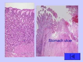 » Stomach ulcer
 