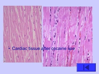 • Cardiac tissue after cocaine use
 